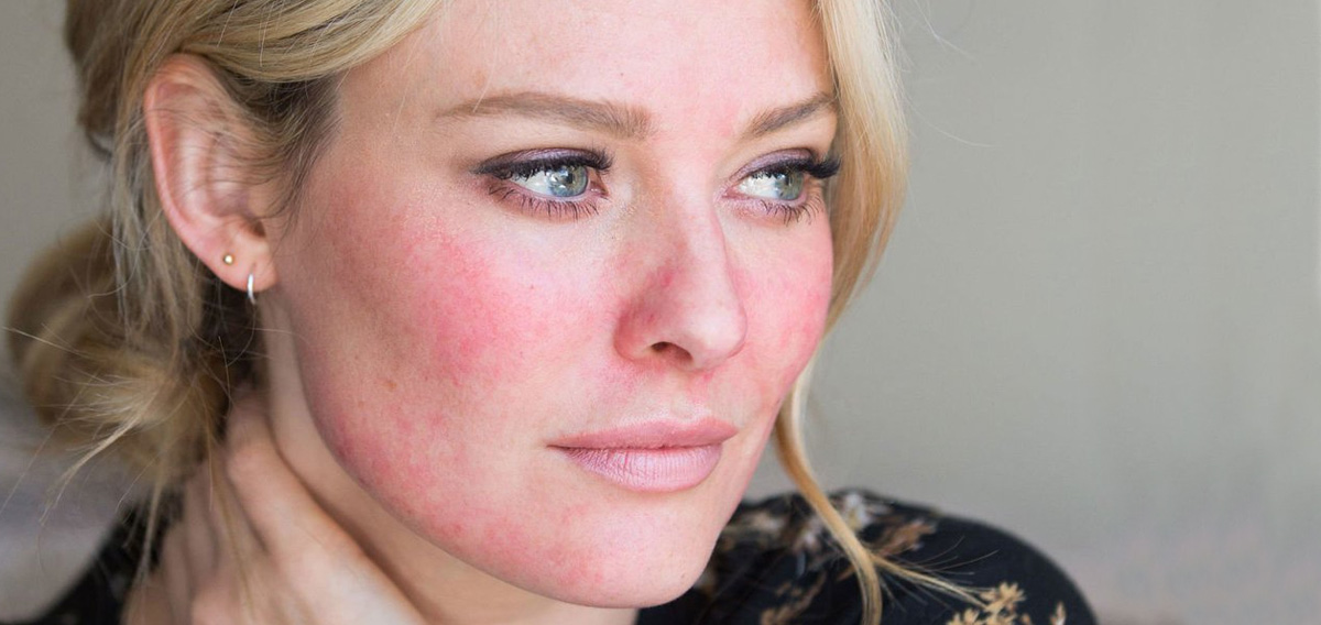 Rosacea