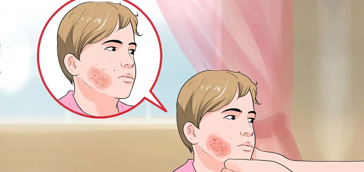 Shingles